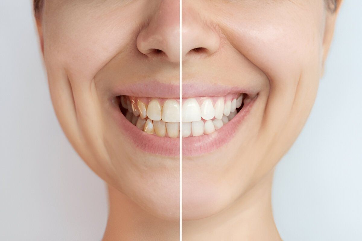 Teeth Whitening in NE Calgary