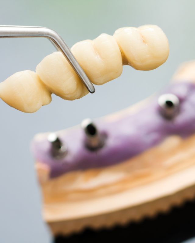 Porcelain Crowns and Dental Bridges Near You
