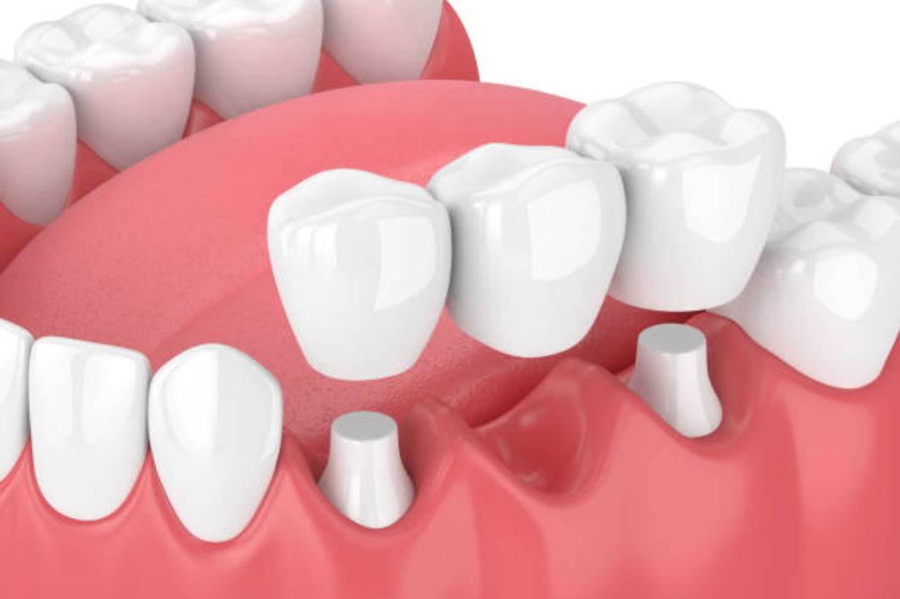porcelain crowns and dental bridges in NE Calgary
