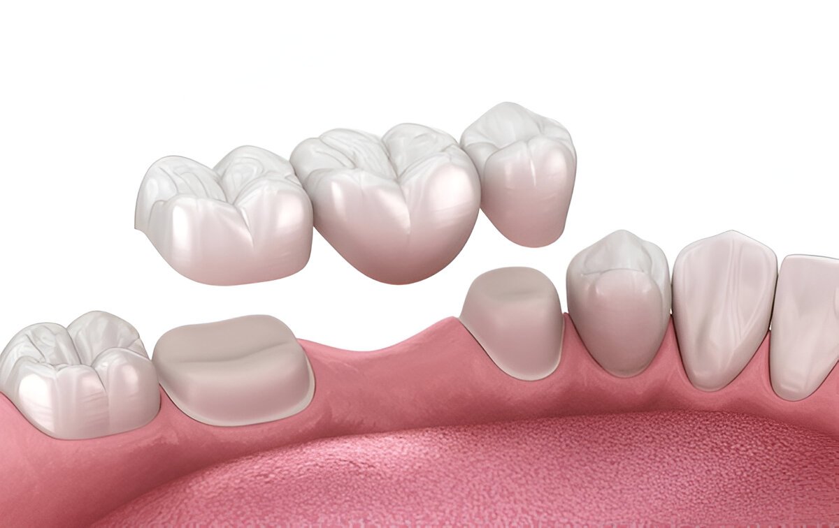 dental bridges in ne calgary