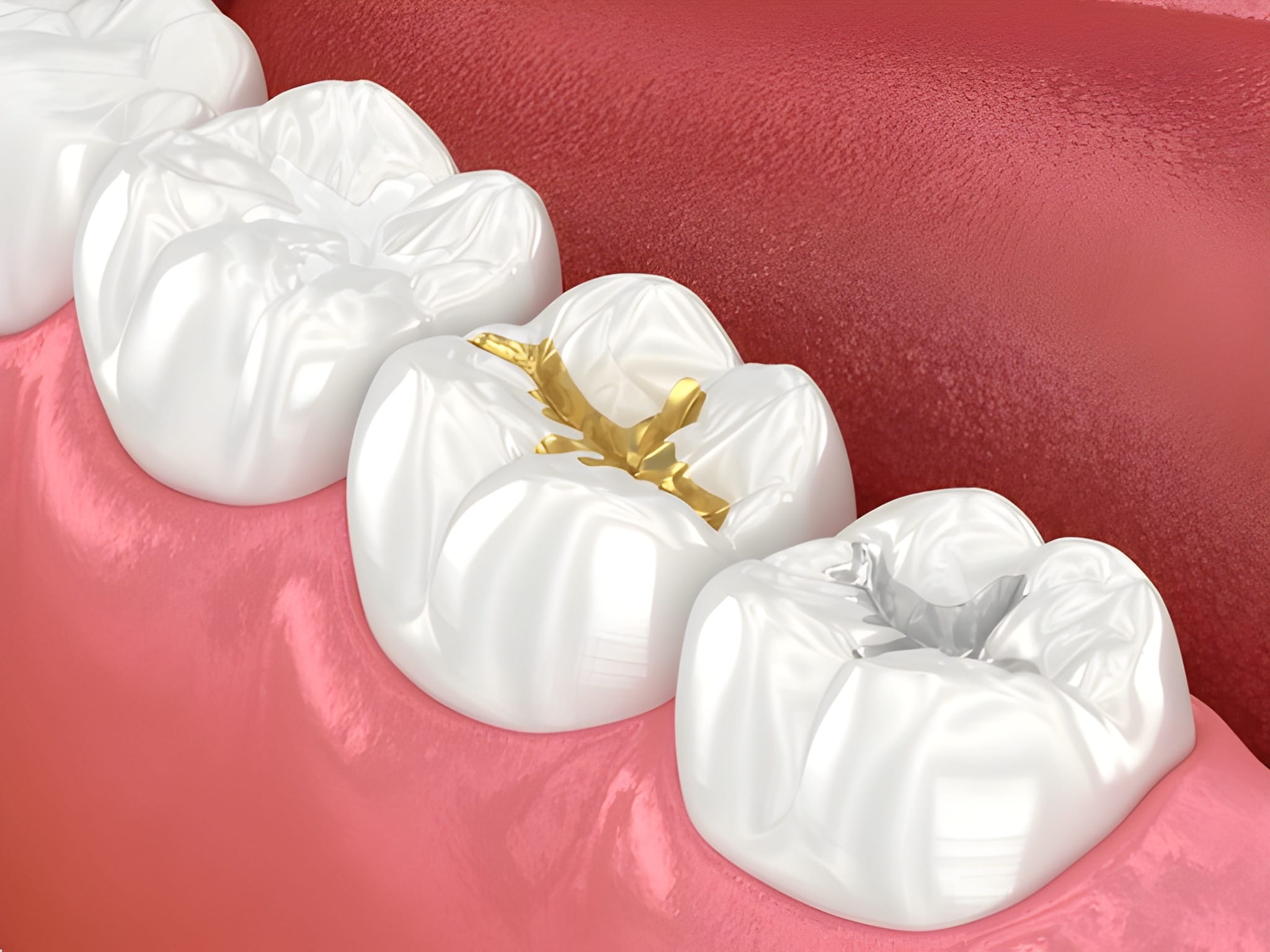 Dental Fillings for Children Near You