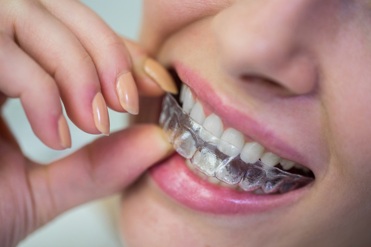can invisalign fix severe crowding dentist explains